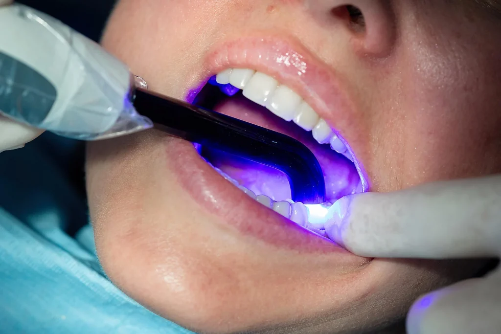 composite bonding east kilbride